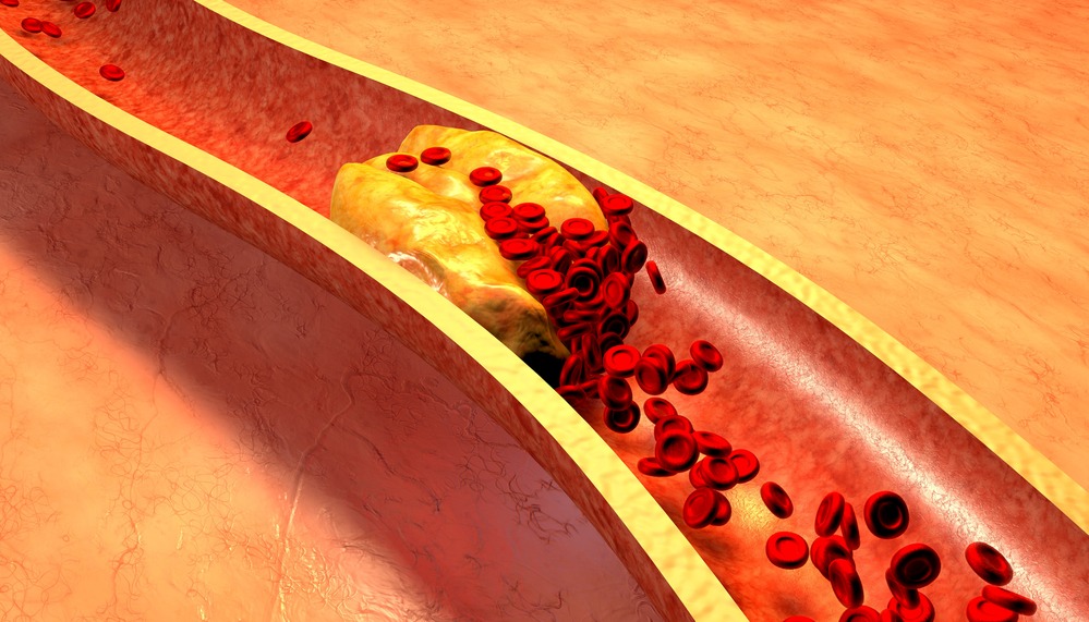 Colesterolo alto: quali alimenti evitare per mantenere il tuo cuore in salute