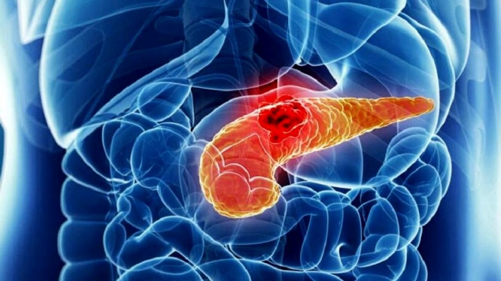 Cancro al pancreas: sintomi.