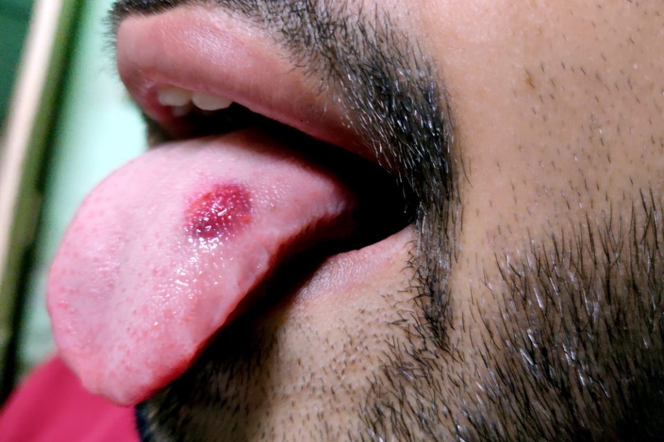 Tumore alla lingua